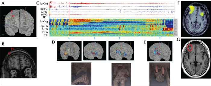 Image description generated by AI: MRI images and SEEG recordings of brain electrodes, highlighting seizure onset and propagation in the frontal lobe.