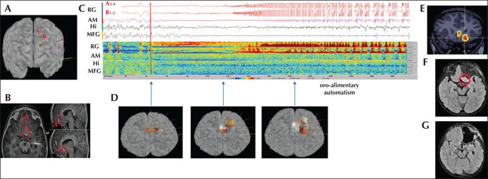 Image description generated by AI: Brain imaging with electrode placements and seizure activity data.