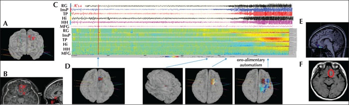 Image description generated by AI: Brain imaging with SEEG recordings showing electrode placements and seizure propagation in patient.