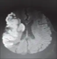 Description de l'image par IA : Image montrant une hypersignal en diffusion sylvienne droite, indiquant un infarctus aigu sylvien droit.
