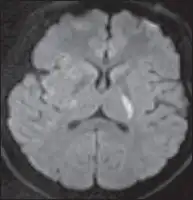 Description de l'image par IA : Image MRI du cerveau montrant une zone de hypersignal en diffusion dans le bras postérieur de la capsule interne gauche.