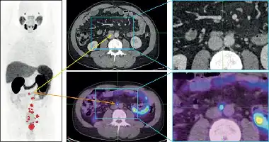 Description de l'image par IA : Images de PET-CT montrant l'absorption du traceur dans des tissus sains et des métastases. Comparaison avec CT seule et PET-CT ciblant PSMA.